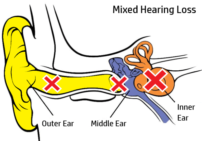 Hearing Loss ALLTONE Hearing Solutions hearing-loss-alltone-hearing-solutions